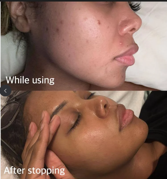 Salicylic Acid Acne Removing